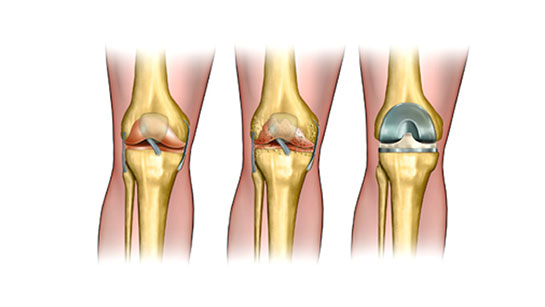 Faster Recovery from Joint Replacement or Implanted Prosthetic Surgery