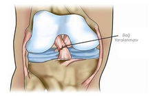 Diz Yan Bağ Kopması Belirtileri ve Tedavisi