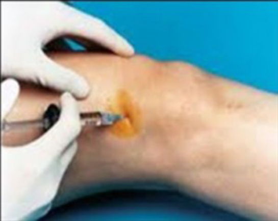 Diz İğnesi Kullanımı ve Faydaları Nelerdir?