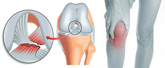 Dizde Menisküs Belirtileri ve Tedavisi